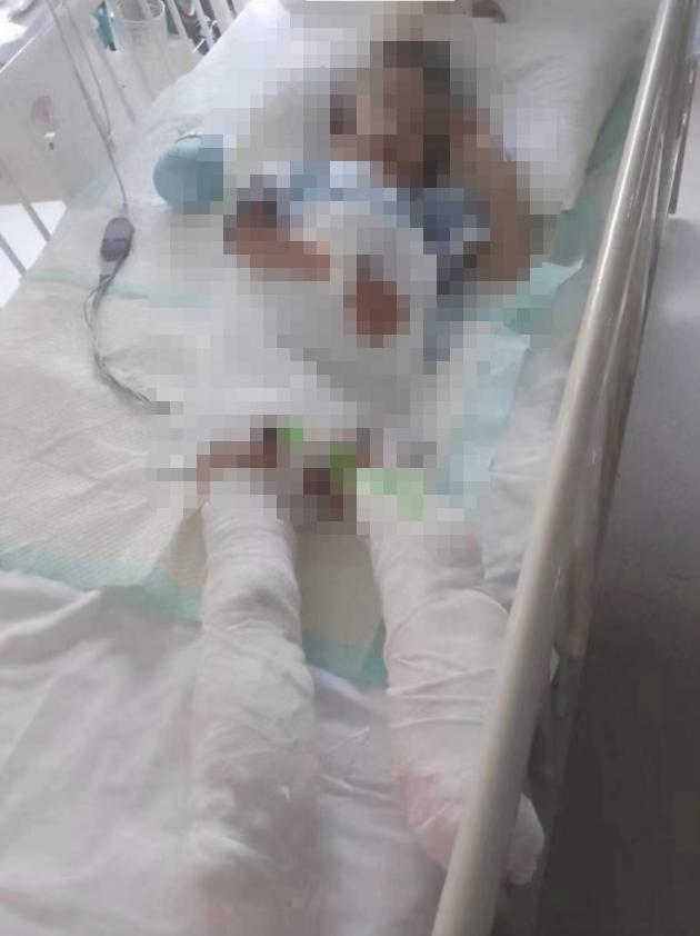 逆境中的舞者，双腿截断的人生之旅
