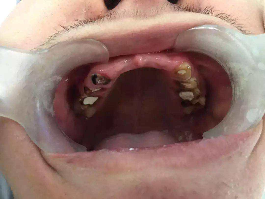 一次拔十几颗牙会怎么样