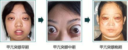 甲亢UP主的心路历程