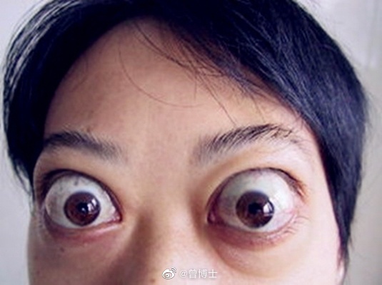 娶甲亢女后悔的案例，深度解析与反思