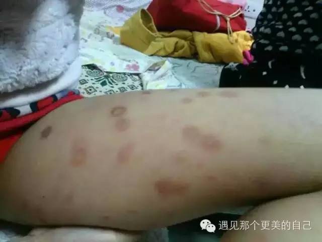 揭秘输头孢过敏的症状表现