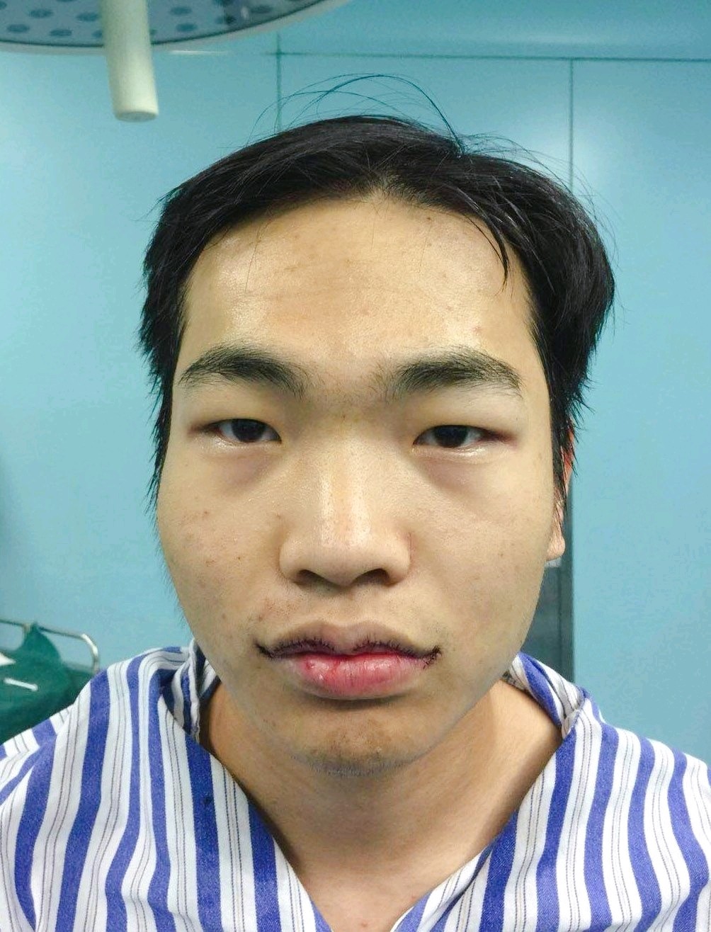 男子突然变丑，下唇比上唇厚一倍，背后的故事引人深思