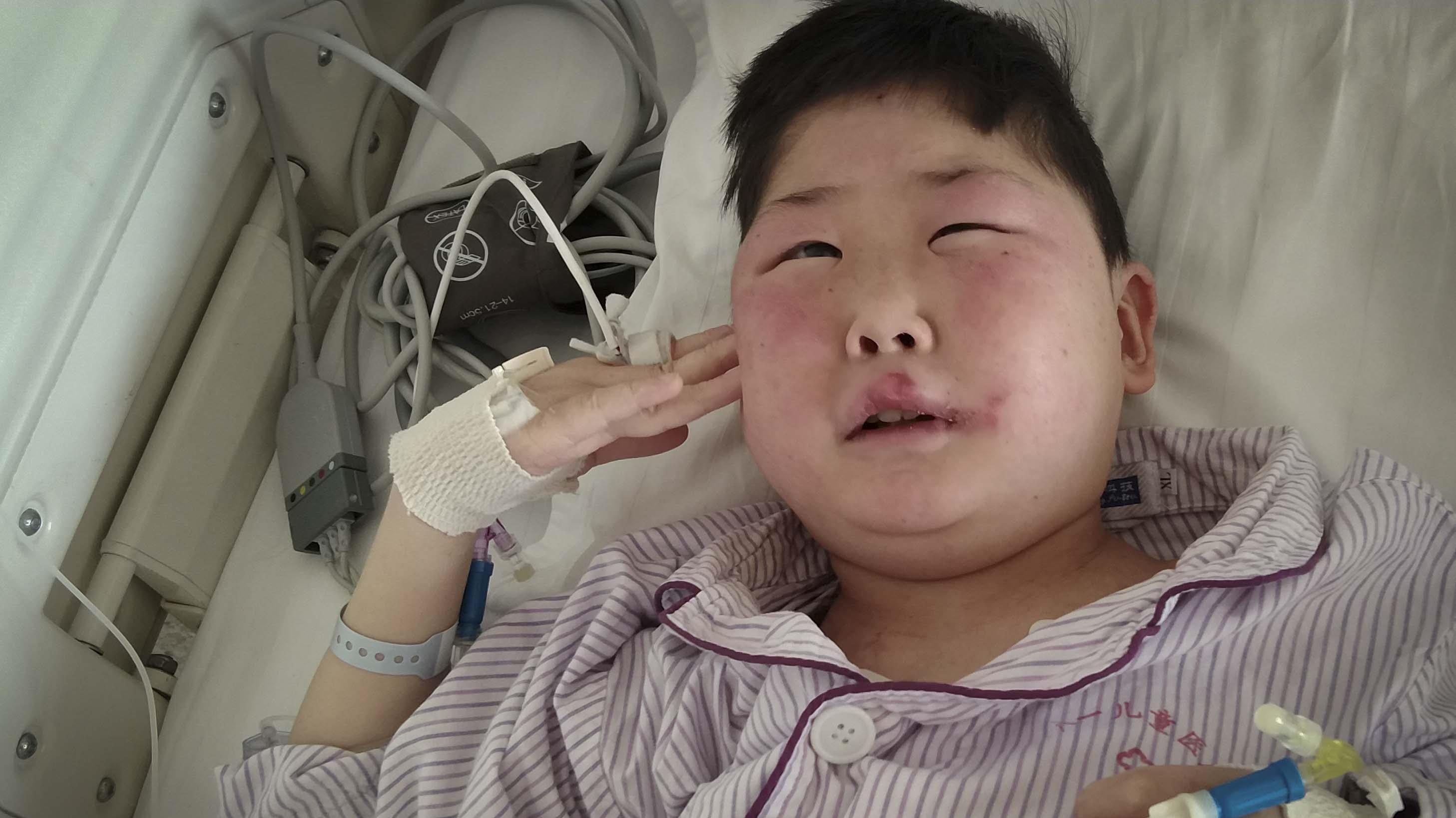 孩子一觉醒来脸肿成发面馒头，深度解析儿童突发水肿现象