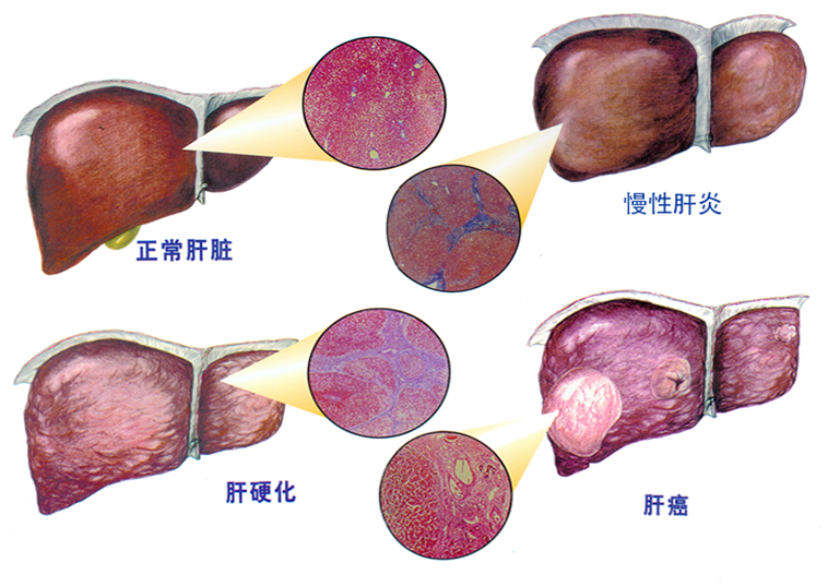 肝纤维化，一种深度解读的疾病，严重吗？能否治好？