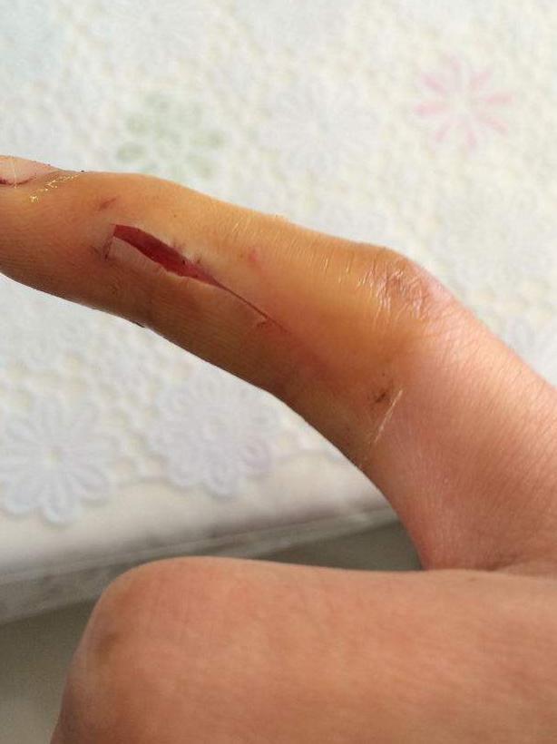 被注射器扎伤需要打破伤风吗？一篇文章解答你的疑惑
